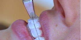 Kvinna vars brackets lossas
