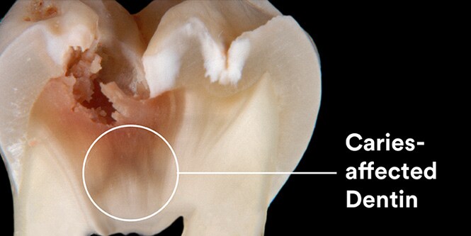 karierat dentin
