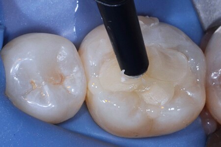 Placera posterior komposit
