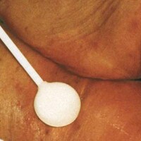 IAD - inkontinensrelaterad dermatit
