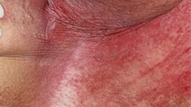 Intertriginös dermatit (ITD)
