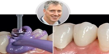 Fall: Implantatbaserad helkeramisk krona
