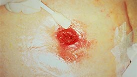 Peristomal hudskada
