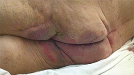 Inkontinsrelaterad dermatit (IAD)
