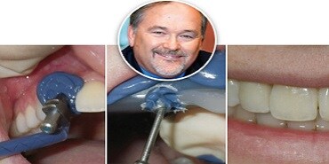Fall: Förutsägbara implantatavtryck
