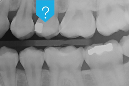 Röntgenbild av en tand som visar radioopacitet för dentala adhesiv
