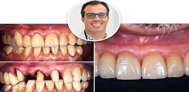 Fall: Fullständig bågrekonstruktioner med hjälp av tre olika cement
