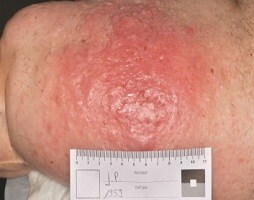 Papillomvirus

